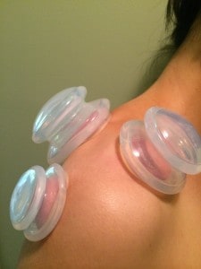 Cupping 2.0: vacuum therapy that doesn’t suck